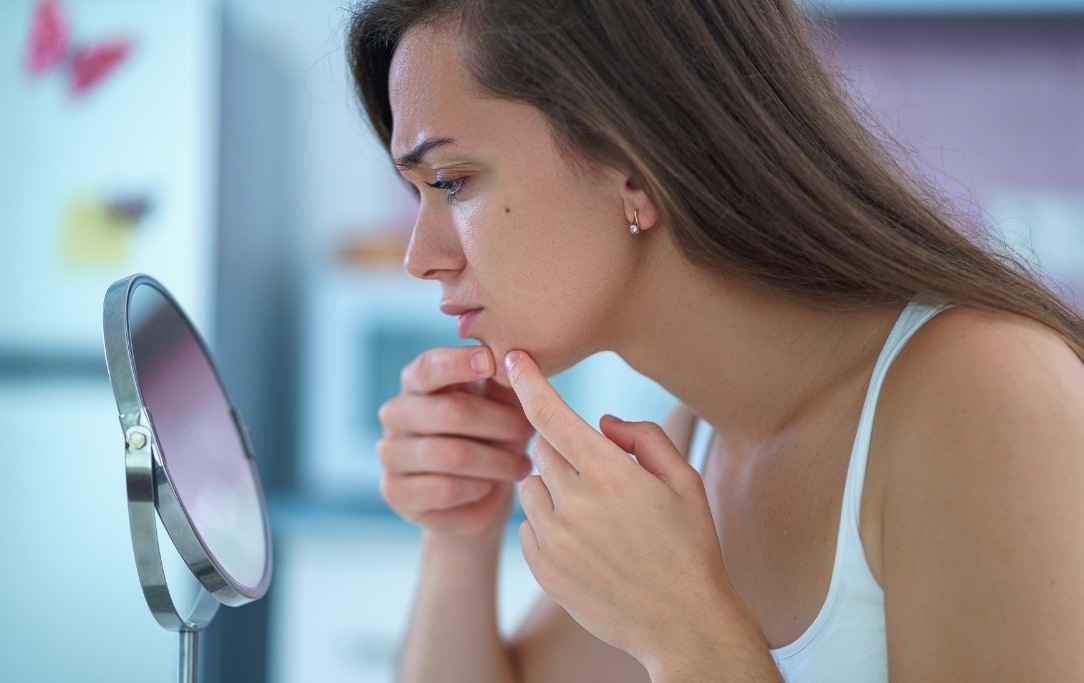 Quali sono le cause dell'acne tardiva? Cause interne ed esterne