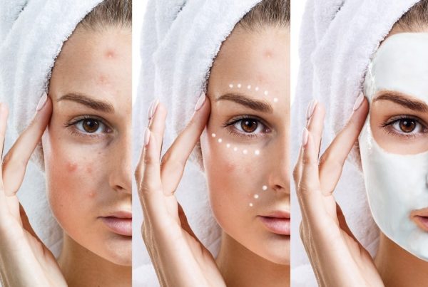 Skincare per pelle acneica: consigli utili ed errori da evitare