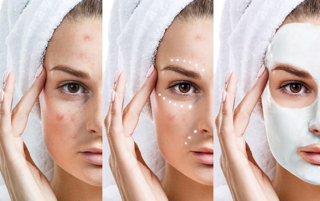 Skincare per pelle acneica: 8 errori da non fare e 8 consigli utili da ricordare