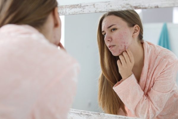 Consigli utili sulla miglior dieta anti acne