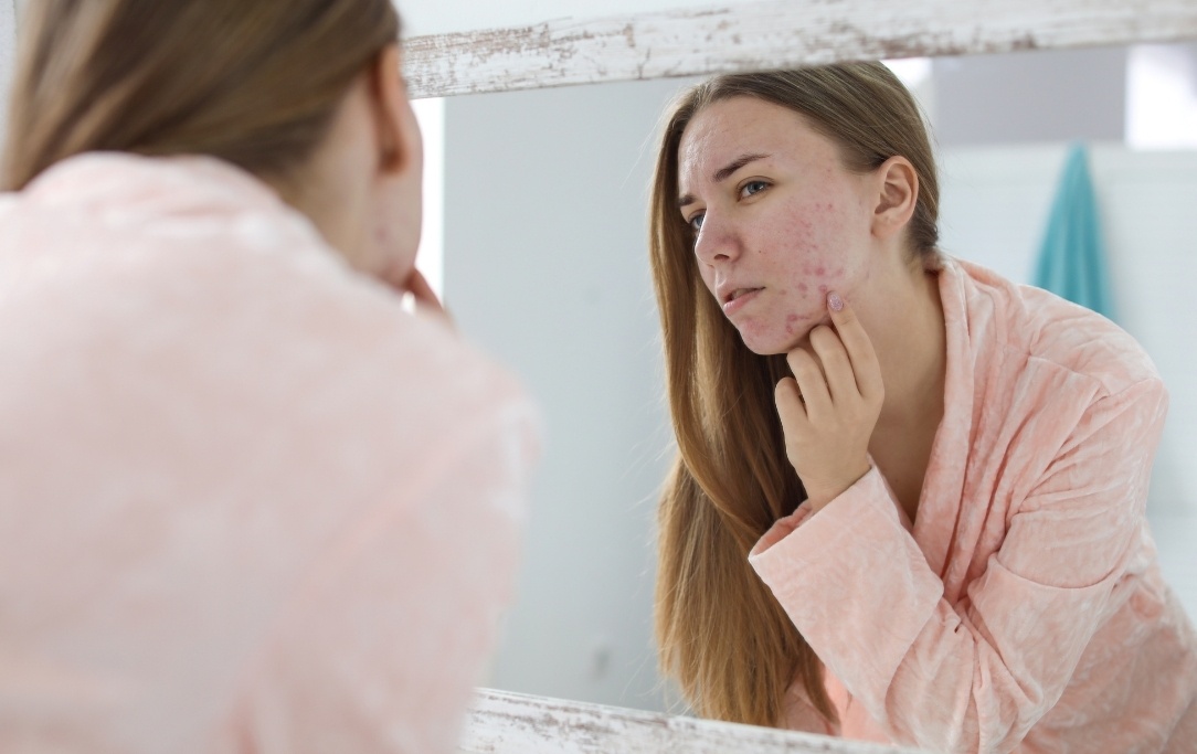 Qual è la miglior dieta anti acne? Consigli pratici e utili