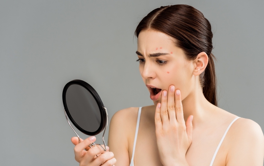 Rimuovi carboidrati complessi e riduci il consumo di latticini per migliorare l'acne tardiva